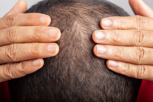Close-up of hands examining thinning hair and a receding hairline
